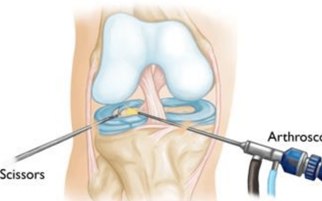 How much is a knee arthroscopy?