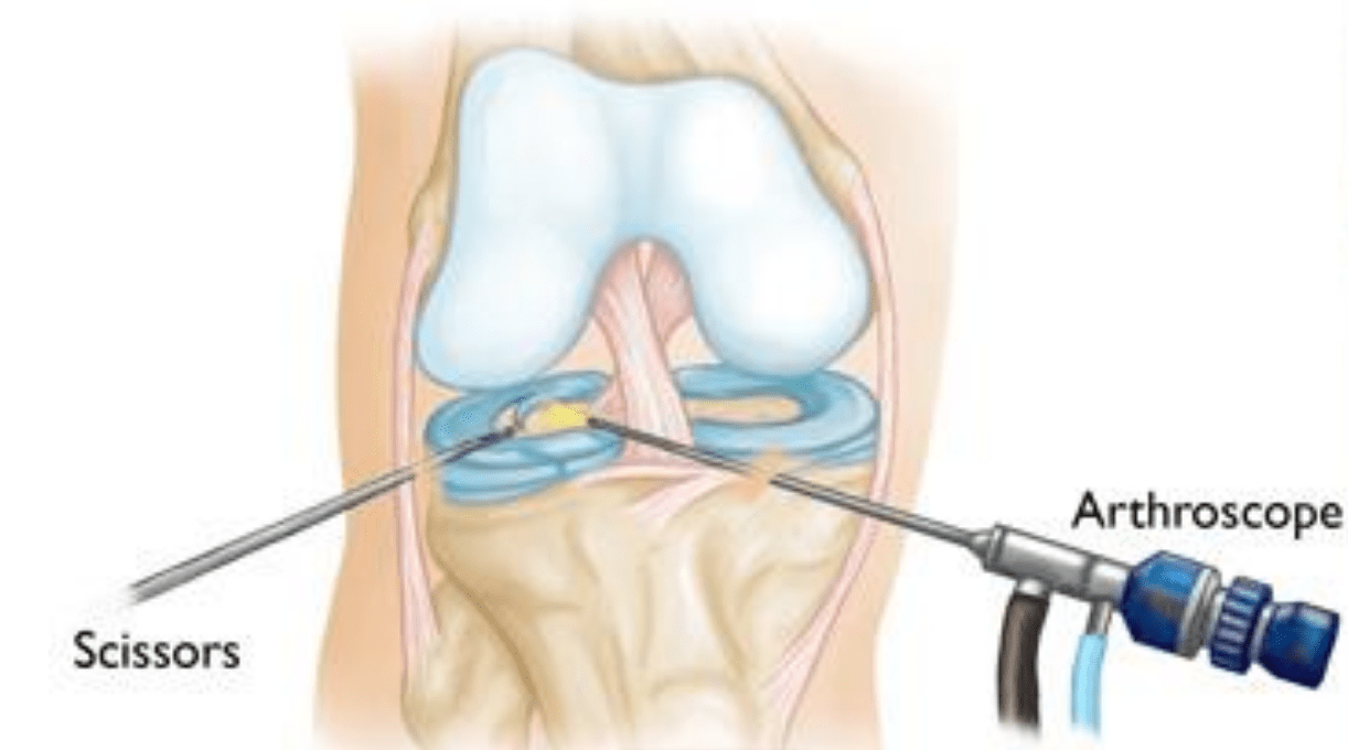 How much is a knee arthroscopy? London Hip & Knee Consultant