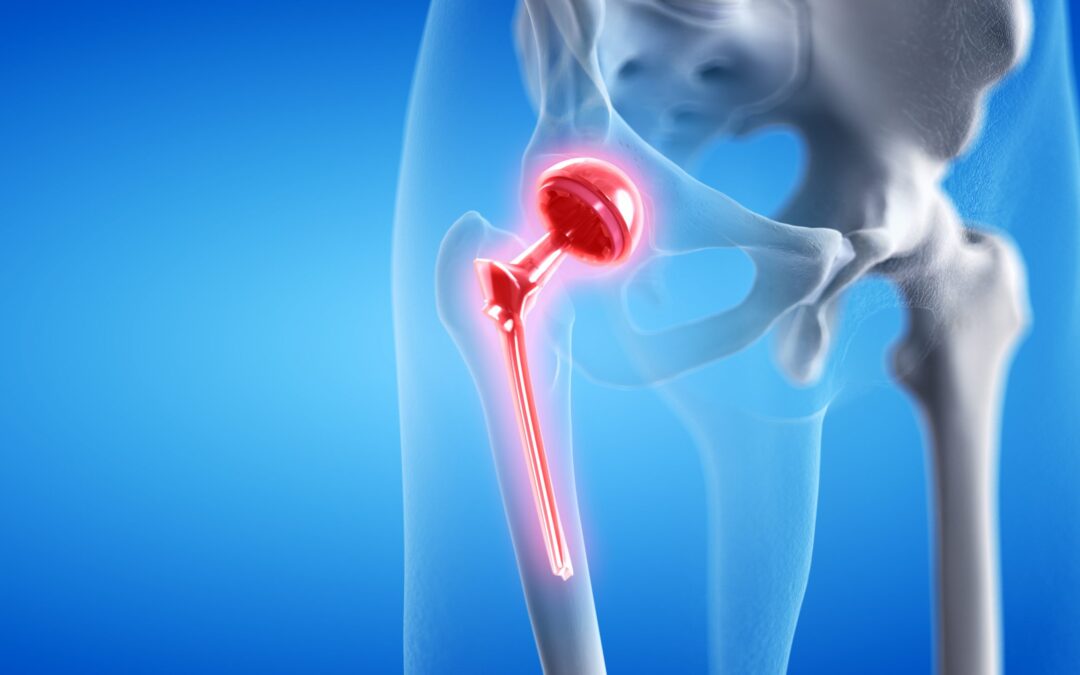 How much is a hip replacement?