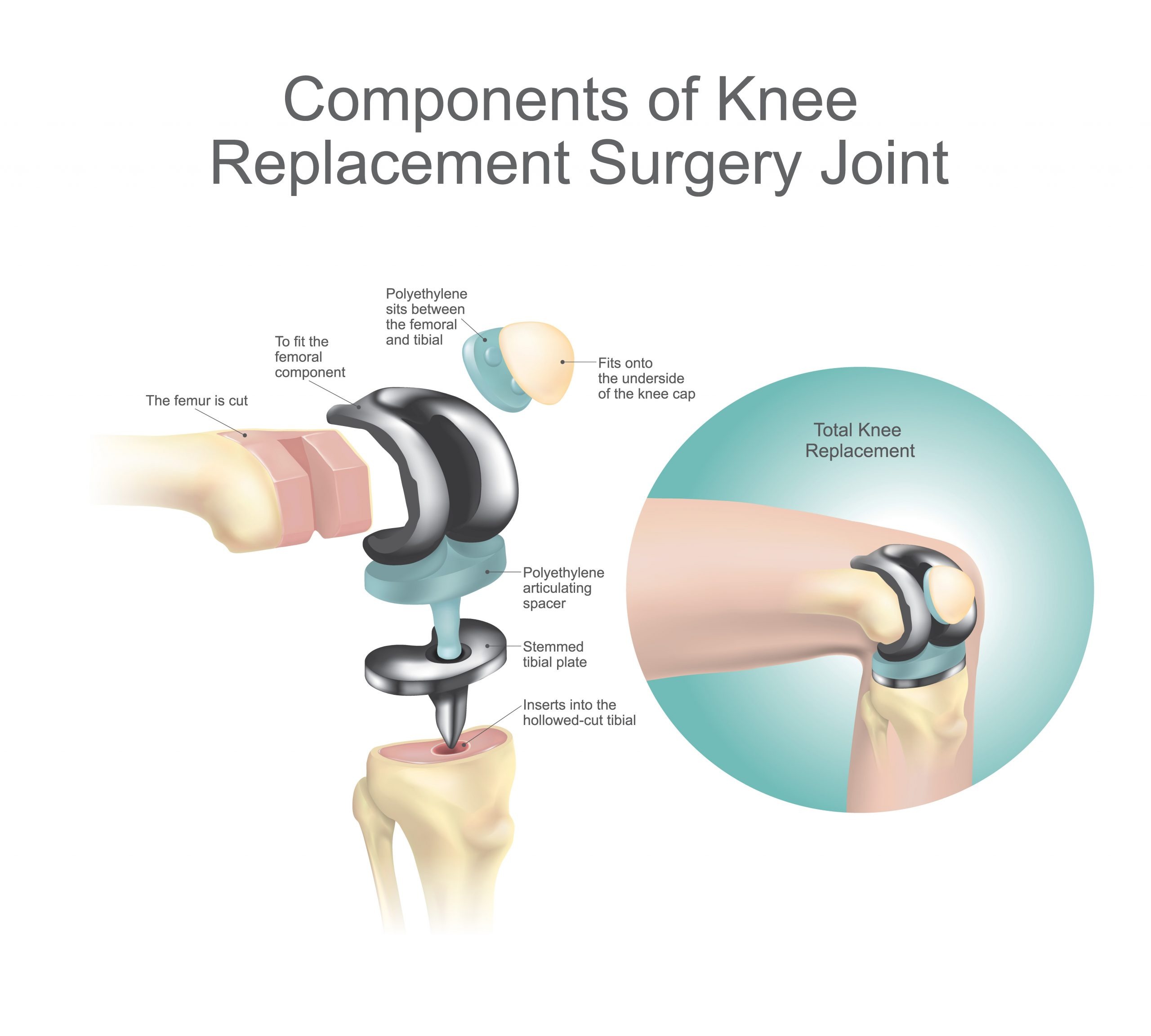 Knee Replacement London Hip Knee Consultant Knee Replacement London Hip Knee Consultant