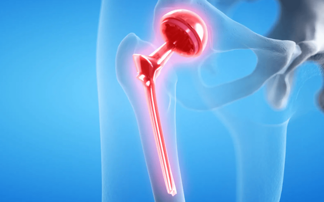 Understanding the Longevity of Hip Implants